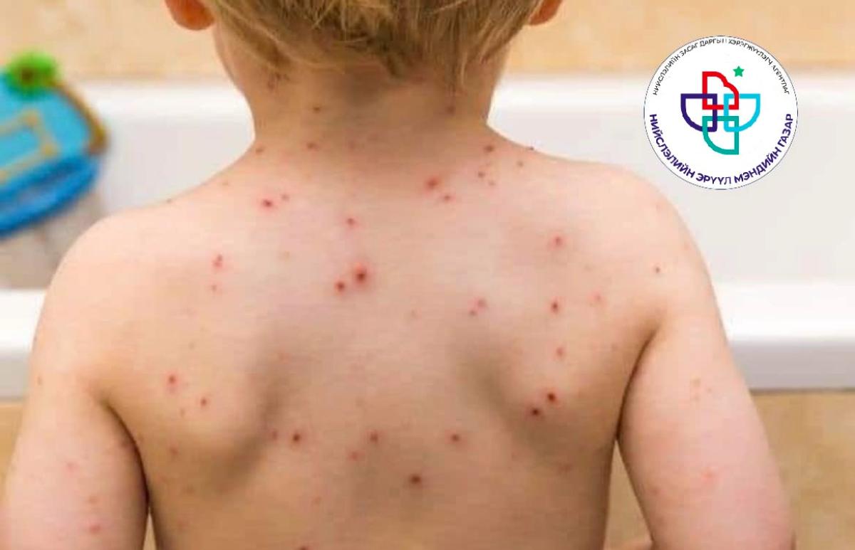 МЕНИНГОКОККТ ХАЛДВАР ИДЭВХЖИЖ ЭХЭЛЖЭЭ