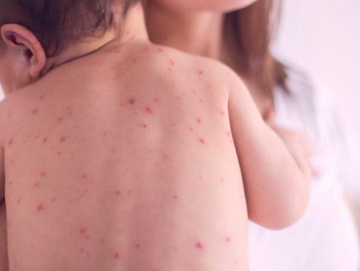 УЛААНБУРХАН ӨВЧНИЙ 27 ТОХИОЛДОЛ ШИНЭЭР БҮРТГЭГДЛЭЭ