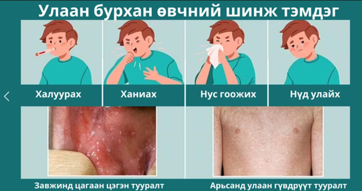УЛААНБУРХАН ӨВЧНИЙ 12 ШИНЭ ТОХИОЛДОЛ БАТЛАГДЖЭЭ